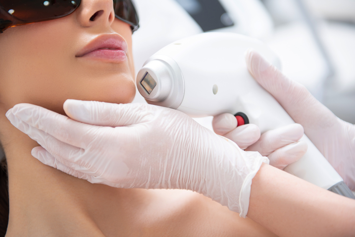 Lady on chin laser hair removal procedure